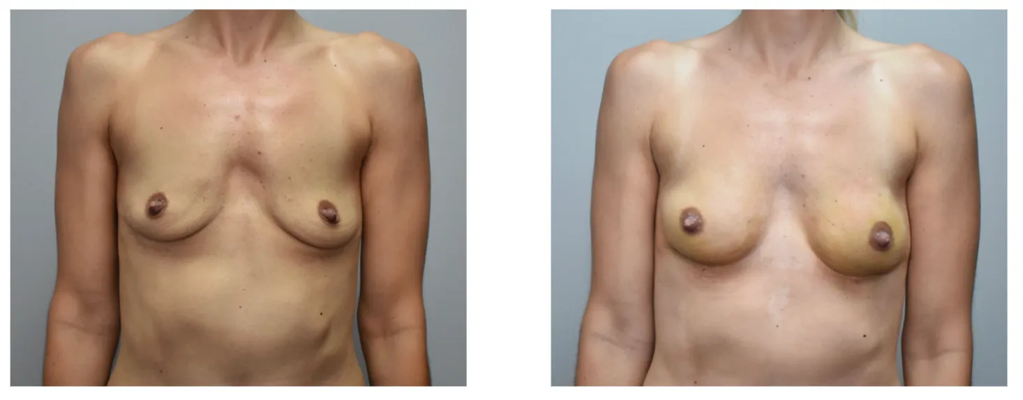 Liposuction candidate results RejuveenMD