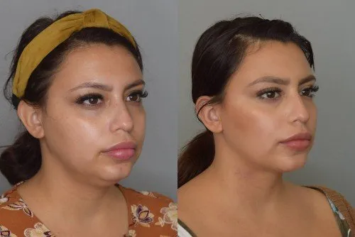 Renuvion skin tightening procedure — RejuveenMD