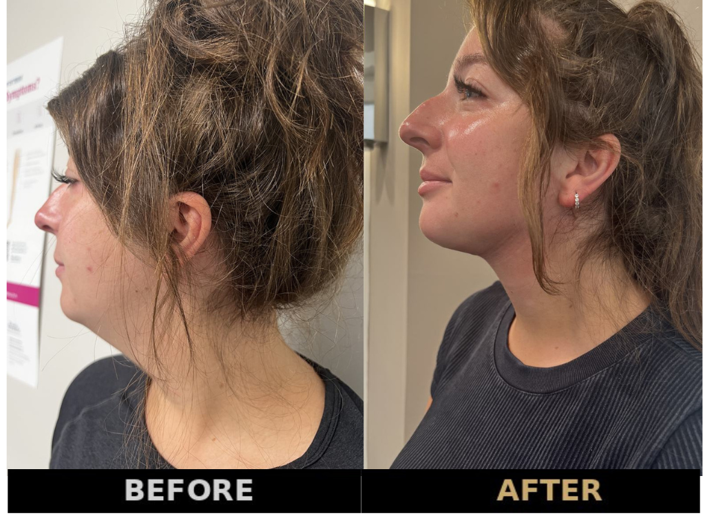 VASER liposuction before and after — RejuveenMD