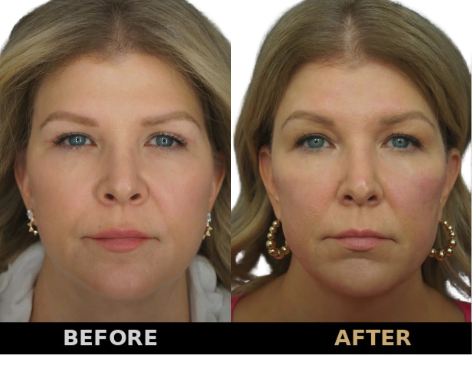 Facial liposuction at Rejuveen — cheek, jowl and neck fat removal for defined facial contours