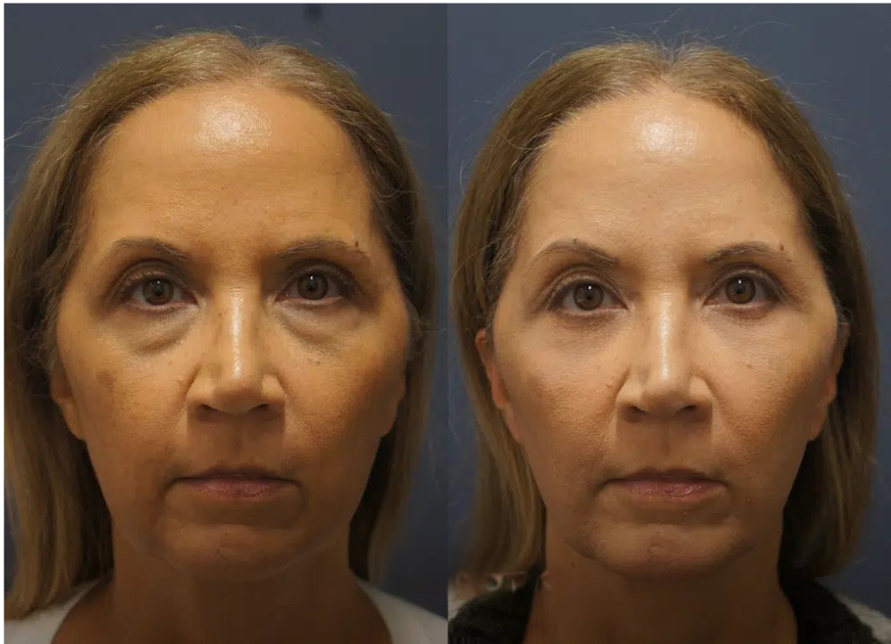 Facial liposuction at Rejuveen — cheek, jowl and neck fat removal for defined facial contours
