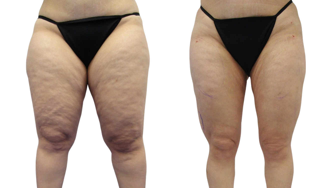 Saddle Bags Outer Thigh – RejuveenMD Palo Alto