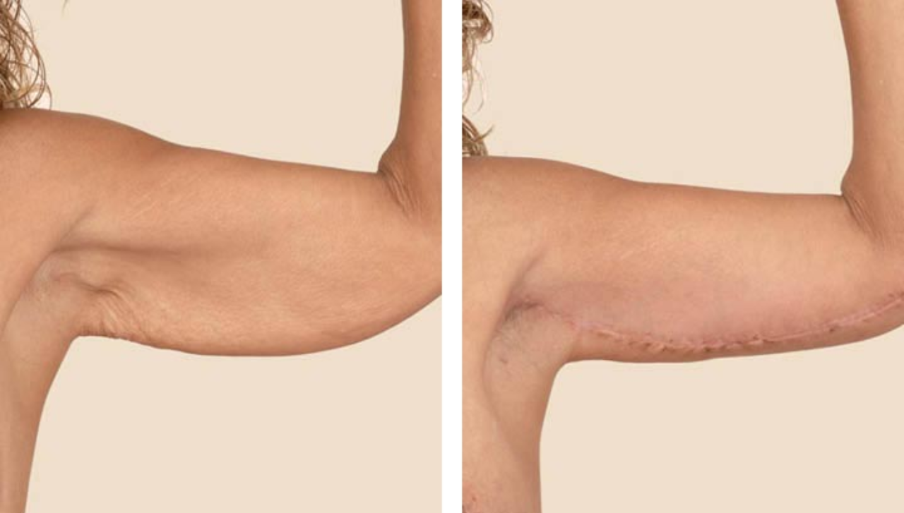 Upper Arm Liposuction Brachioplasty – RejuveenMD Palo Alto