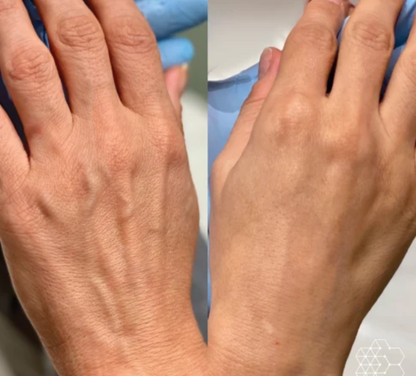 Hand Rejuvenation Filler – RejuveenMD Palo Alto