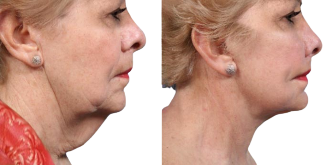 Neck Lift – RejuveenMD Palo Alto
