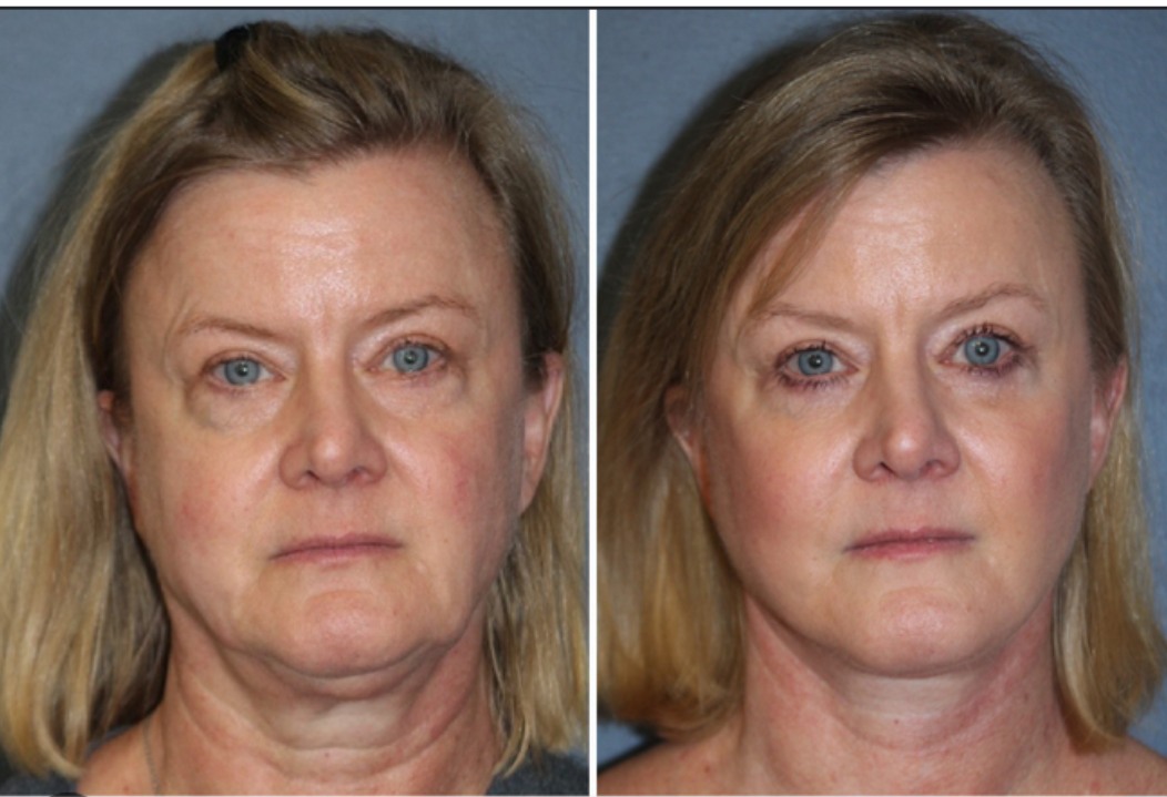 Facelift and facial surgical procedures – RejuveenMD Palo Alto