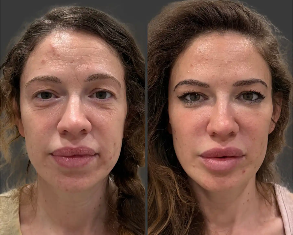 Liquid Face Lift – RejuveenMD Palo Alto