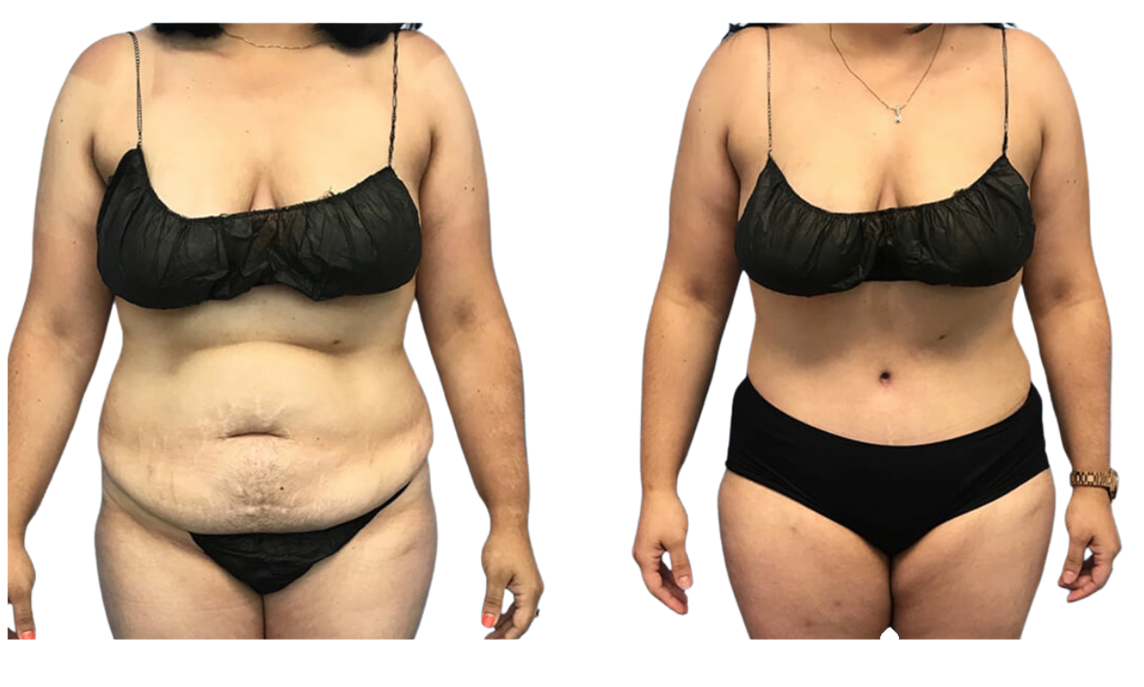 Liposuction tummy tuck body contouring – RejuveenMD Palo Alto