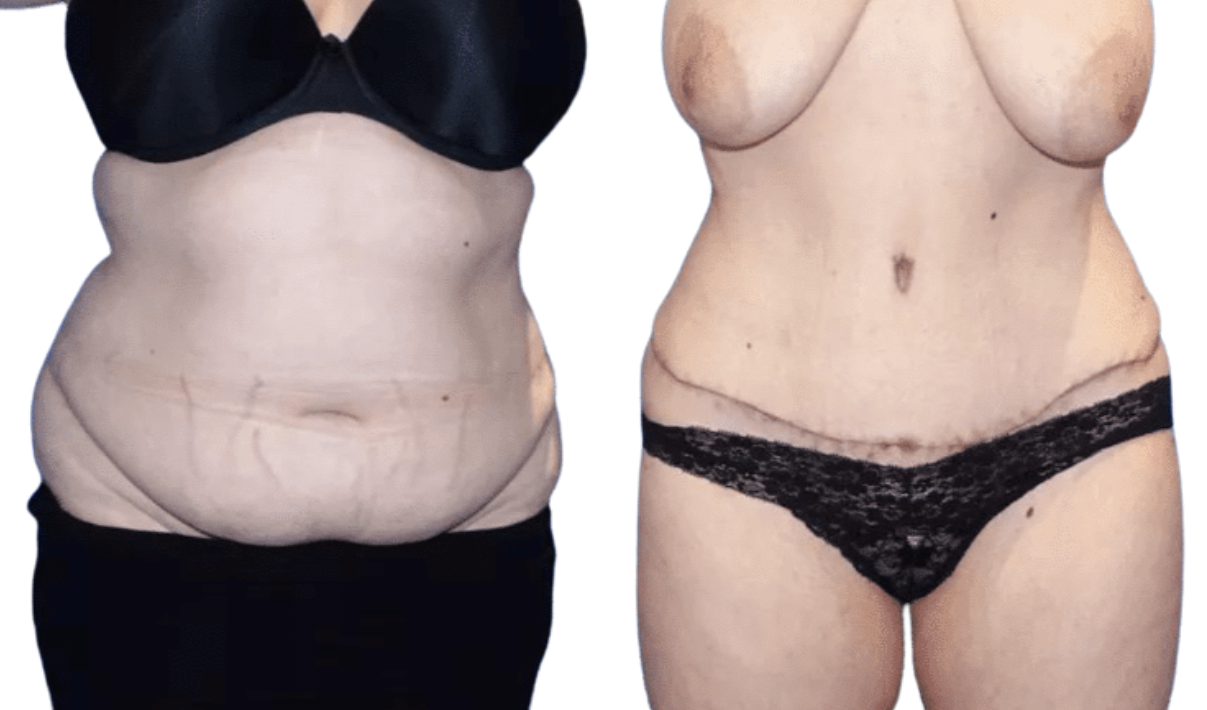 Tummy Tuck Abdominoplasty – RejuveenMD Palo Alto