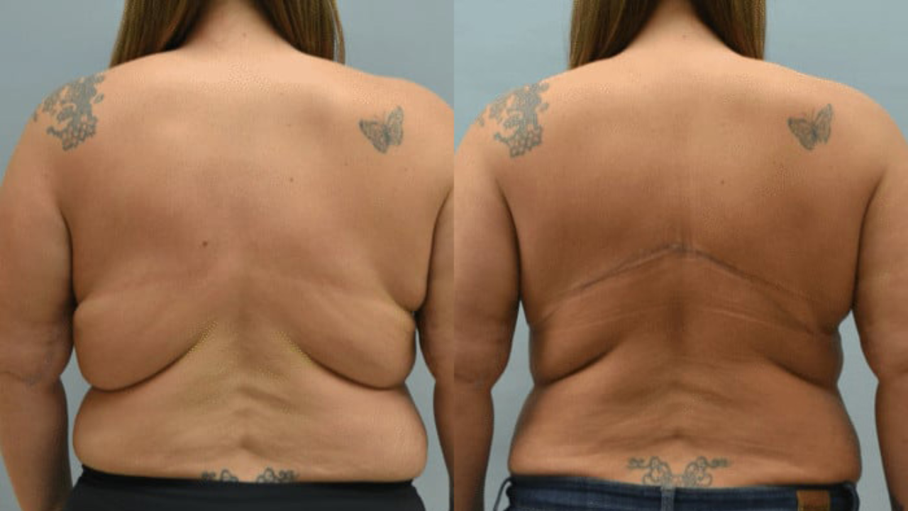 Bra Roll Reduction – RejuveenMD Palo Alto