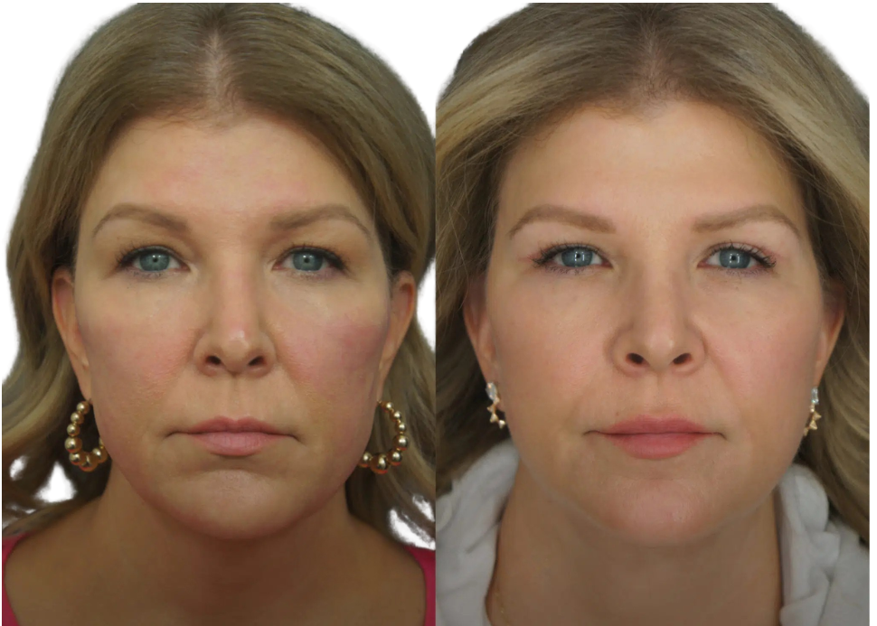 Facial liposuction result at Rejuveen