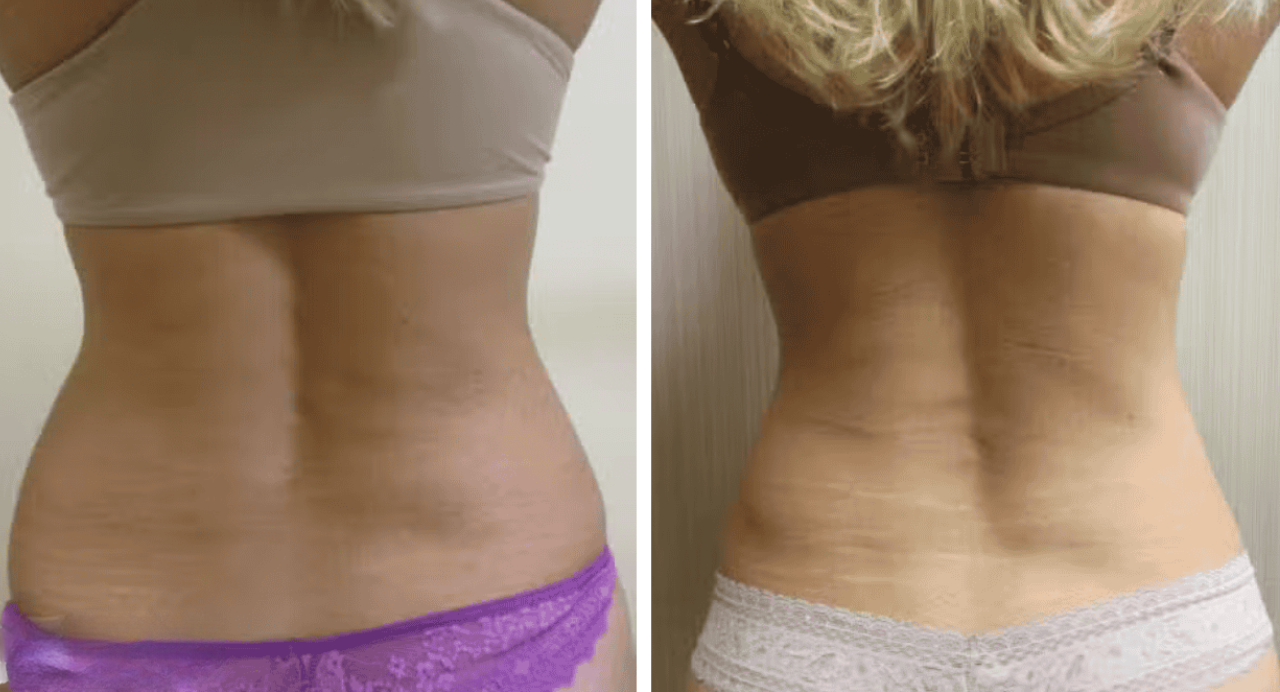 Love Handles Liposuction – RejuveenMD Palo Alto