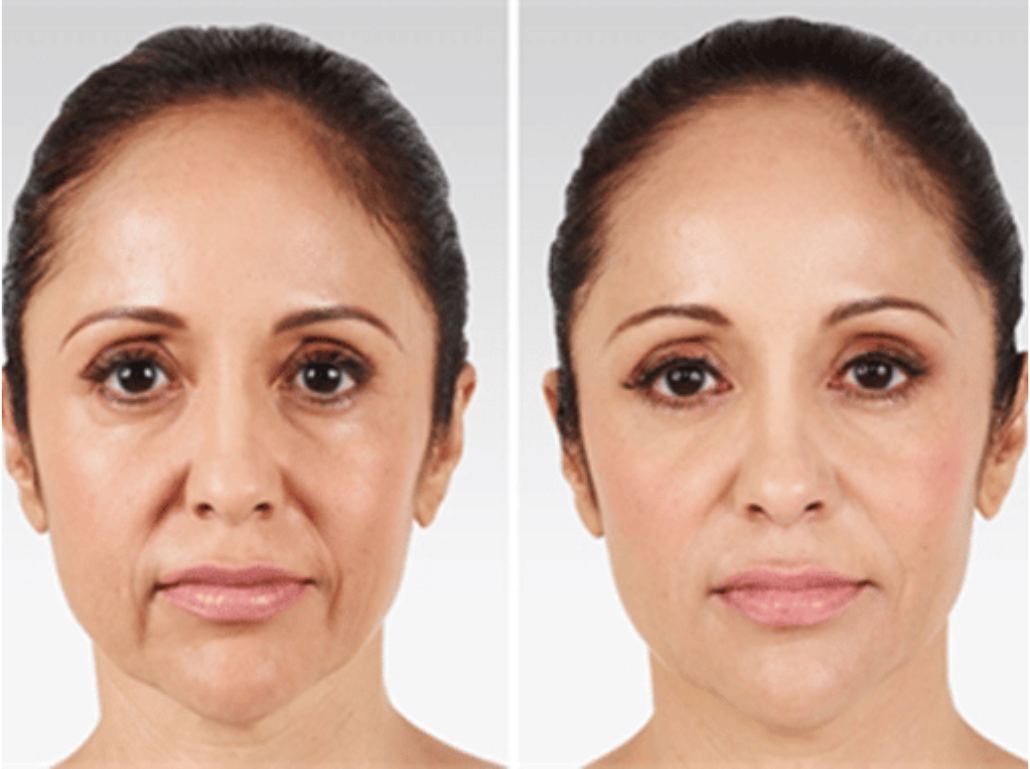 Treatment of Loose Skin – RejuveenMD Palo Alto