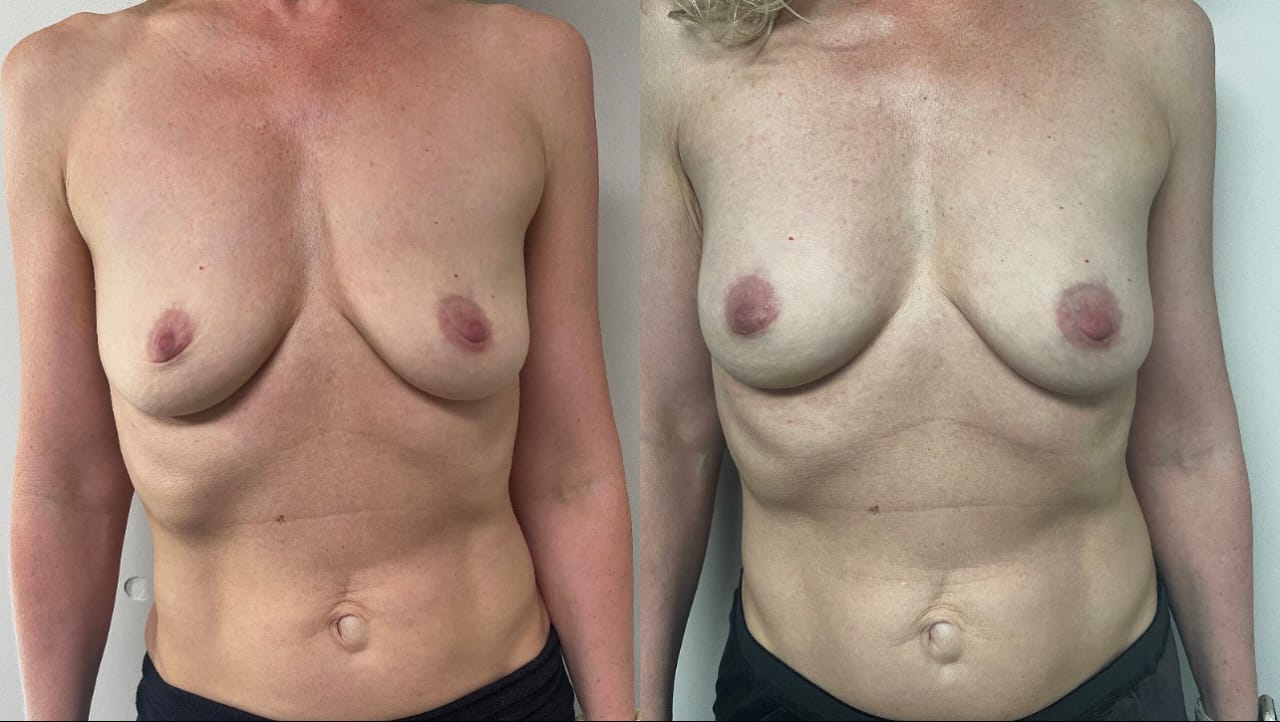 Breast augmentation fat transfer Alloderm keloid scar revision – RejuveenMD Palo Alto