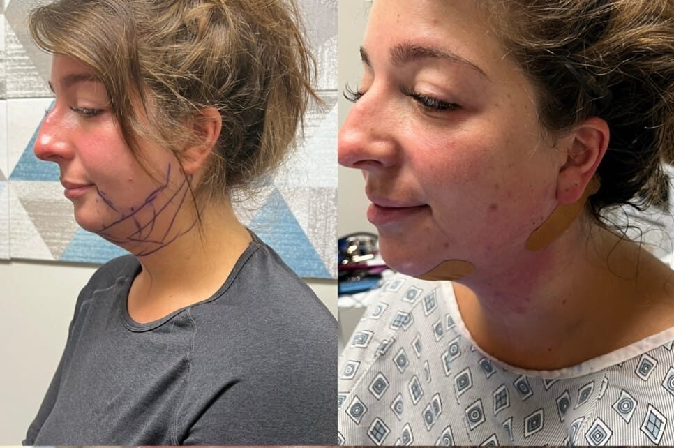 Chin Lift – RejuveenMD Palo Alto
